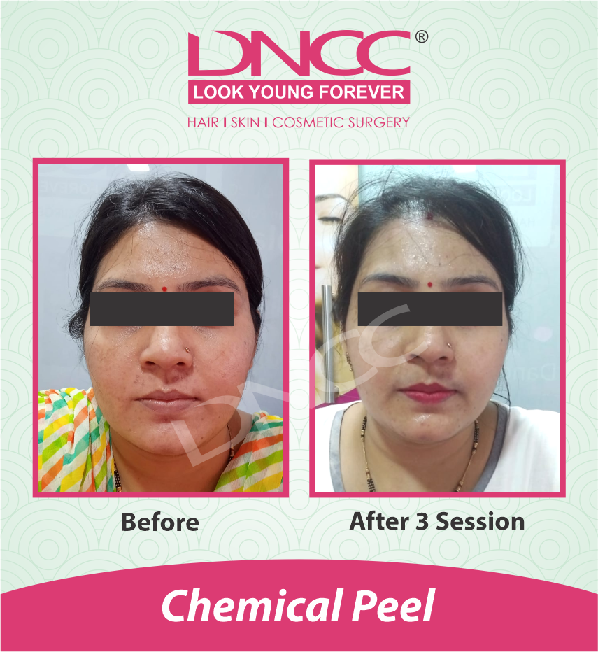 Hair Transplant Transformation 1